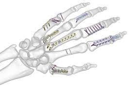 Bone Fixation Plate Market Industry Analysis Till 2028
