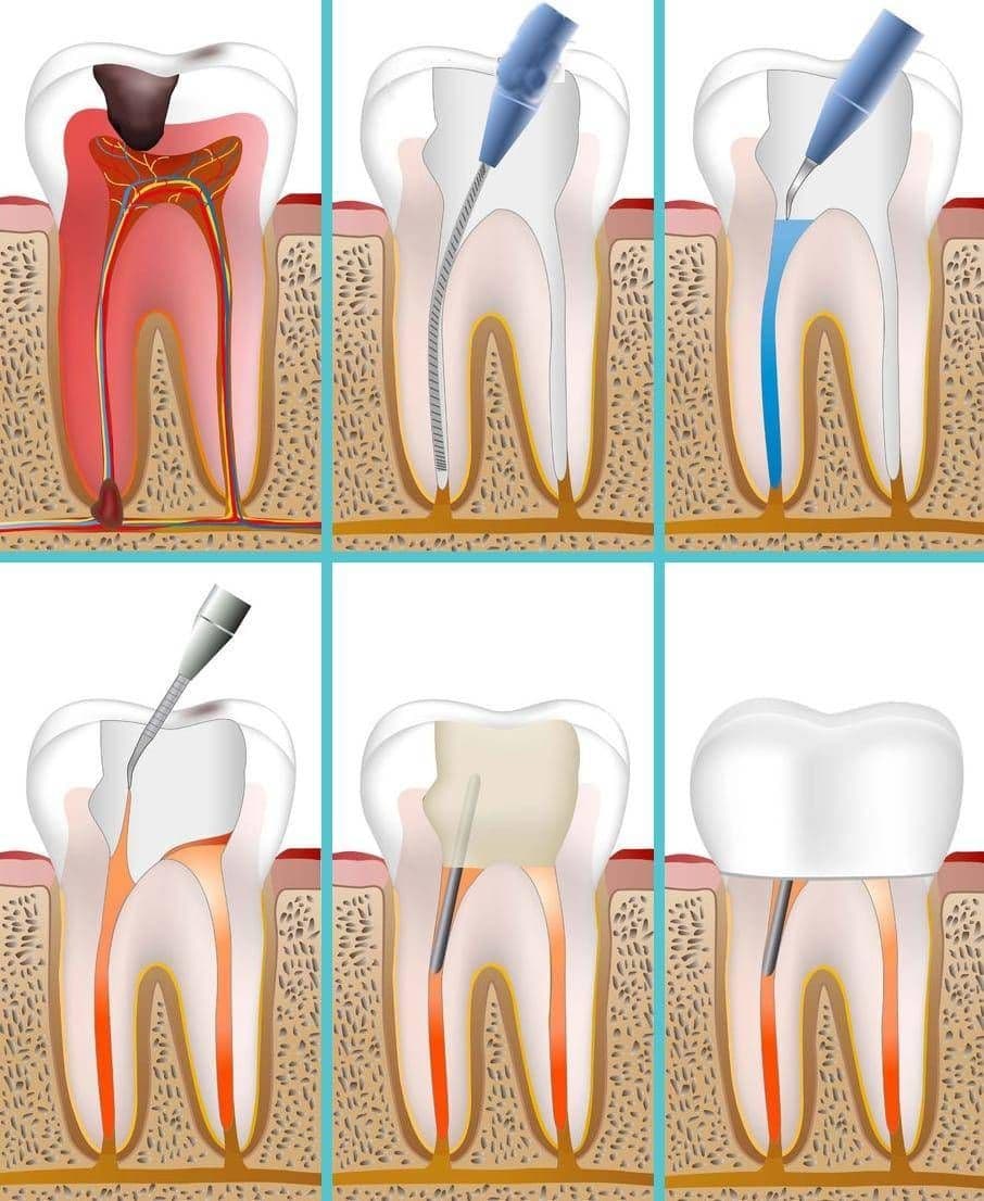 Burs and Endodontic Files Market Research Insights With Upcoming