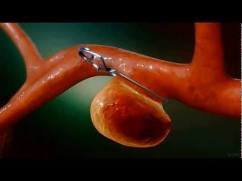 Global Cerebral Aneurysm Clips Market 2022: Covid-19 Impact 2028