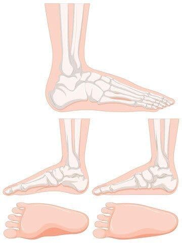 Causes and Treatment of Flat Feet