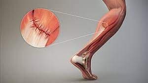 Muscle Strain Is Most Effectively Treated With Pain O Soma.