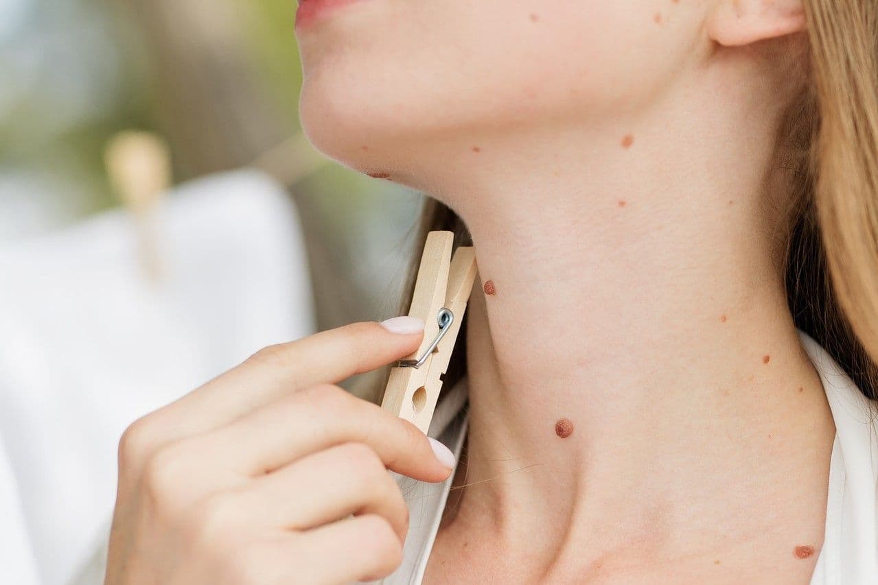 Nuvei Skin Tag Remover Reviews All You Need to Know About Offer!
