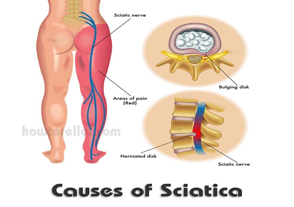 Chiropractic Treatment for Sciatica Relief
