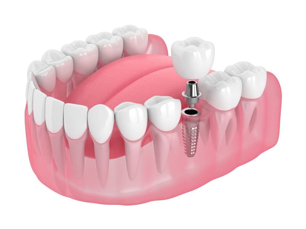 Dental Implant Cost: Factors That Influence Pricing