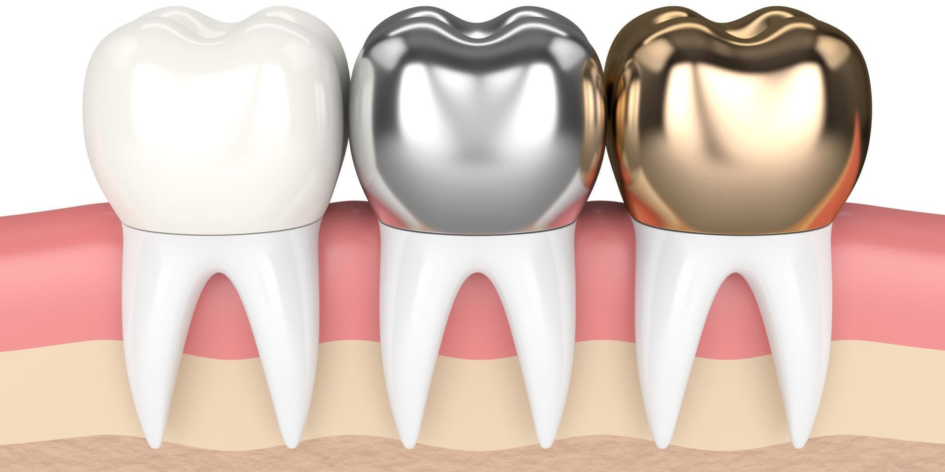 Dental Crowns: Improving Bite Alignment and Chewing Efficiency