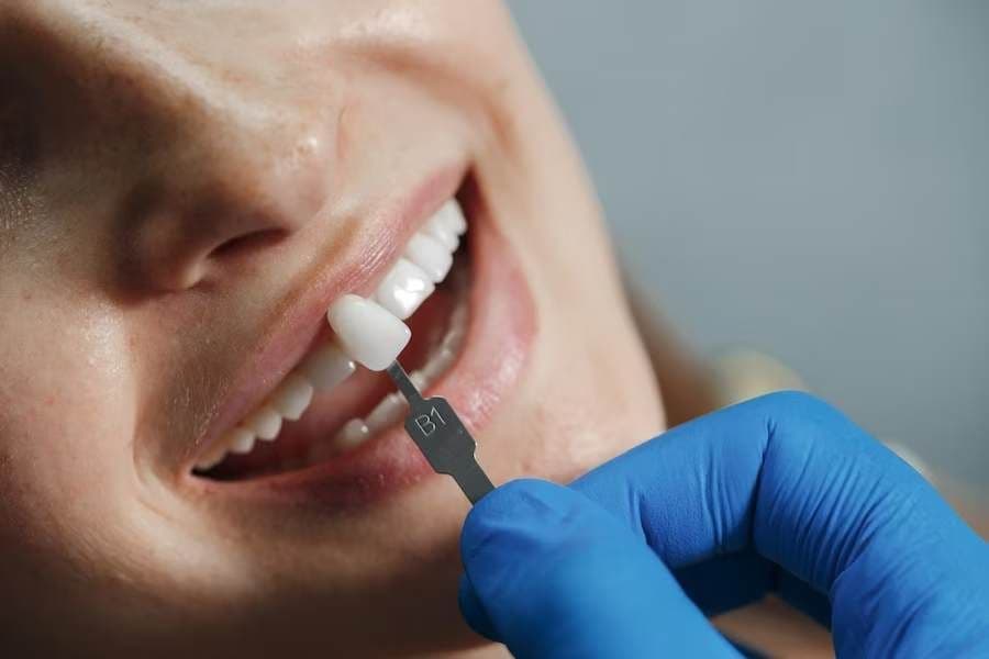 10 Reasons to Get Dental Veneers Treatment