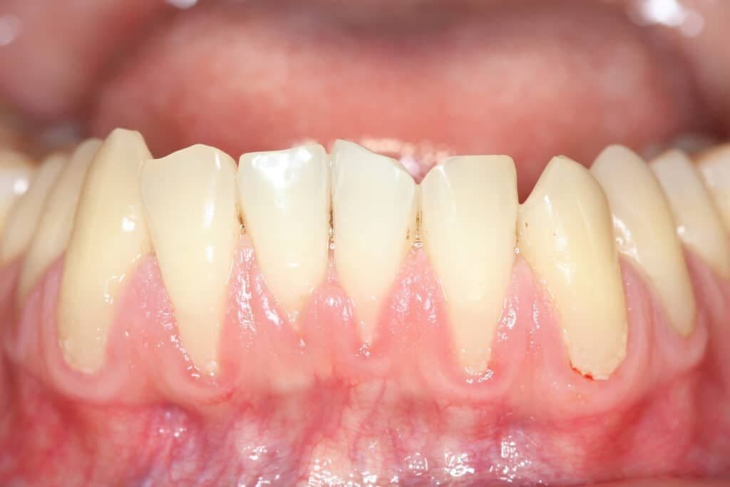 How to Treat Gum Disease at an Affordable Price?