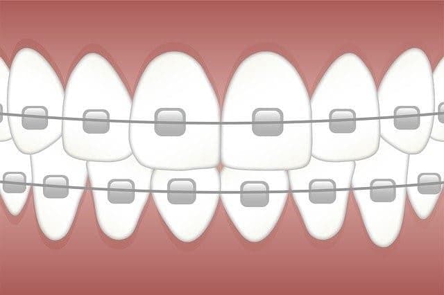 What Are the Advantages of Dental Bonding?