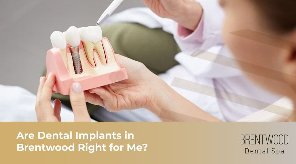 Are Dental Implants in Brentwood Right for Me?
