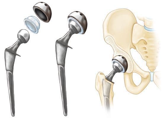 Artificial Hip Prosthesis Market Trends & Growth Outlook 2028