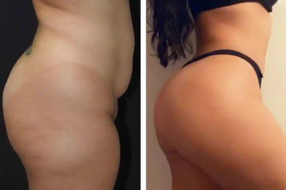 Liposuction and Insurance Coverage in Dubai