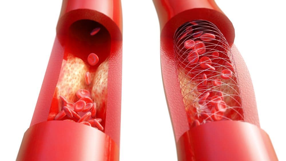 Bioresorbable Vascular Scaffold Market 2022 Size, Growth Factors