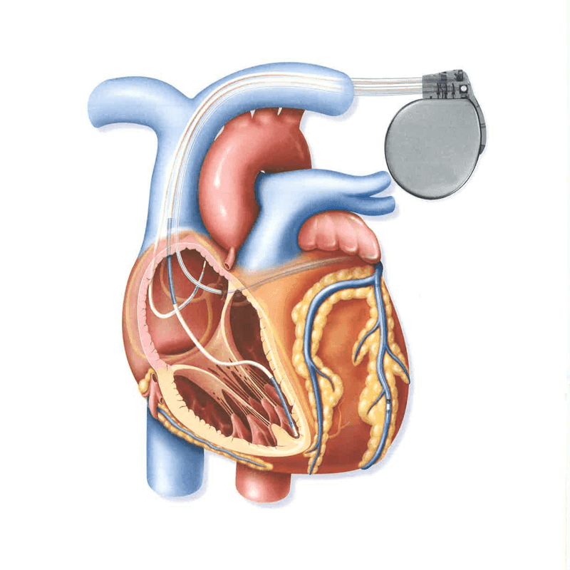 Cardiac Resynchronization Therapy Devices Market Report to 2028