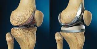 Cementless Total Knee Arthroplasty Market Forecast Report