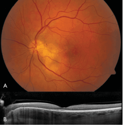 Choroidal Neovascularization Market Report, 2022-2028 | Growth
