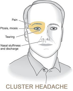 Cluster Headache Syndrome Market Research Report 2028