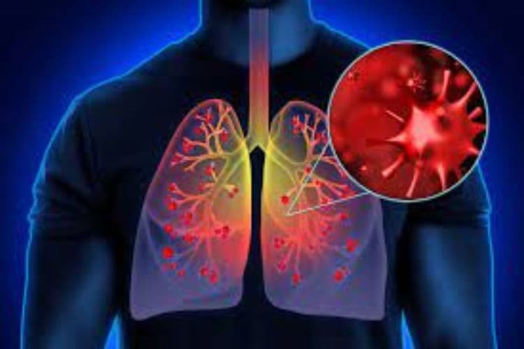Covid-19, Here Are 5 Ways to Take Care of Your Lungs
