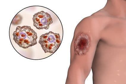 Cutaneous Leishmaniasis Drugs Market Size, Overview