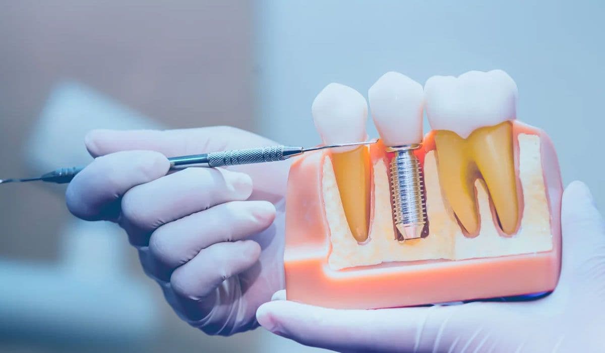 Dental Implants: Step-by-Step Treatment Guide