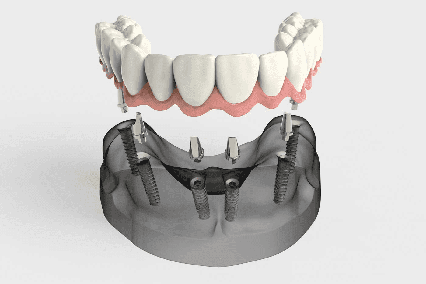 Dental Implants and Prosthetics Market Size, Overview