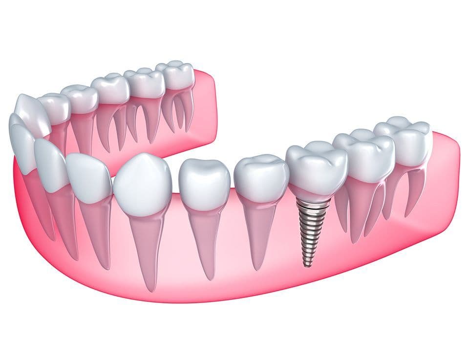 Dental Implants in Pakistan: Cost, Procedure, and Benefits