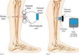 Electrical Bone Growth Stimulators Market Outlook, to 2028
