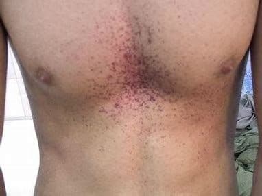 Fabry Disease Treatment Market Latest Trends and Report 2028