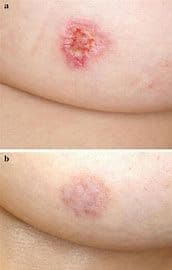 Folliculotropic Mycosis Fungoides Treatment Market Report 2028