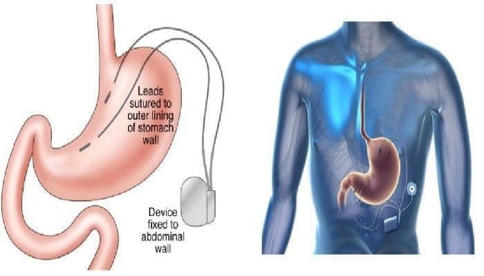 Gastric Electrical Stimulation Systems Market Size, Growth, 2030