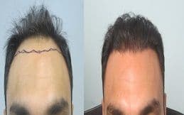 The Ultimate Guide to Hair Transplant Procedures in Riyadh