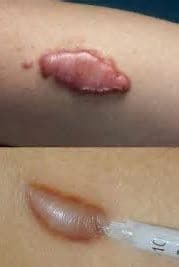 Hypertrophic and Keloid Scar Treatment Market Report Till 2028