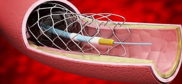 Interventional Cardiology and Peripheral Vascular Devices Market