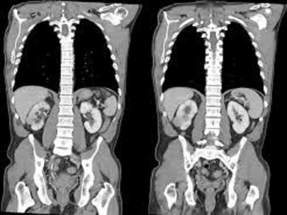 Intravesical Bacillus Calmette Market Report & Forecast to 2028