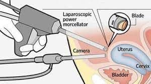 Laparoscopic Power Morcellators Market Landscape 2028
