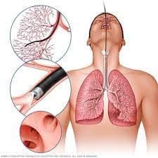 Lung Cancer Diagnostic Tests Market Outlook Research Report