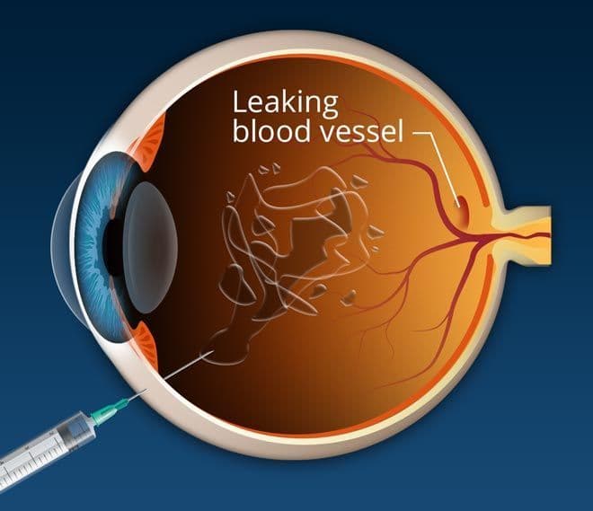 Macular Degeneration Treatment Market In-Depth Analysis Report
