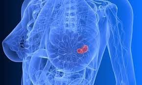 Metastatic Breast Cancer Treatment Market Trends Analysis 2028