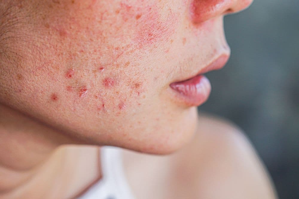 Non-Invasive Scar Removal Options That Work