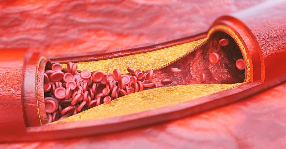 Global Peripheral Vascular Devices Market Size 2023-2028