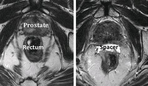 Radiation Proctitis Treatment Market – Exclusive Industry Reports