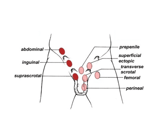Undescended Testicle Surgery Cost in Pakistan