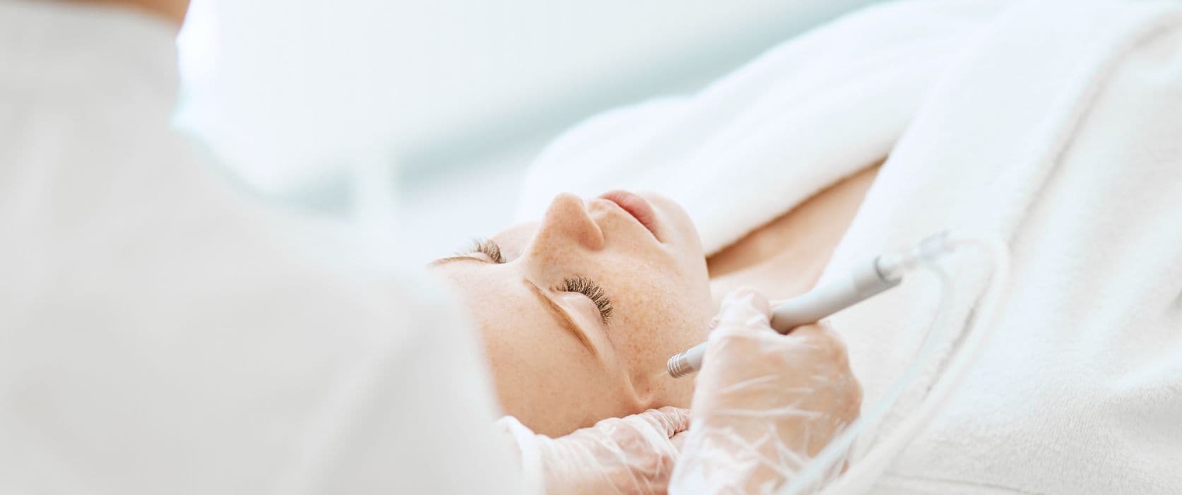 Top 5 Benefits of Getting a Chemical Peeling