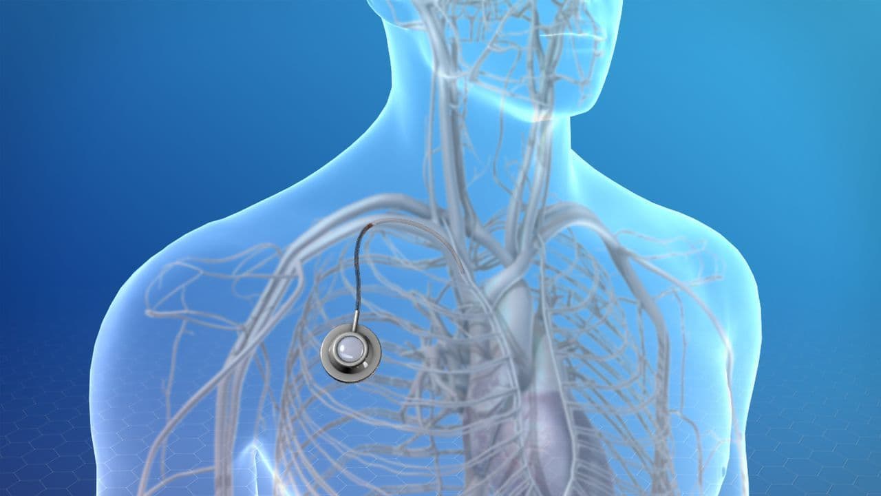 Totally Implantable Access Port Market Forecast Report to 2028