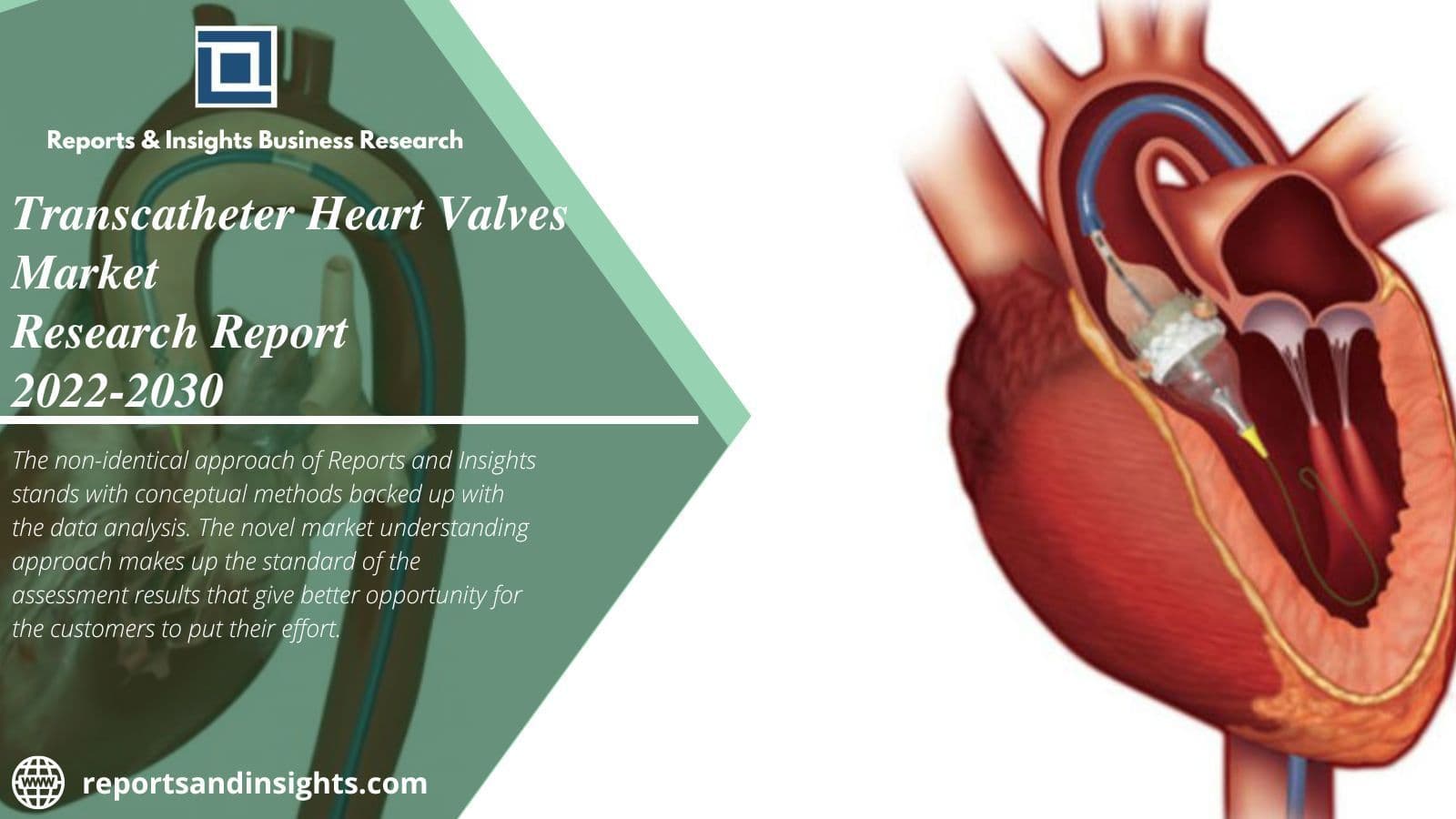 Transcatheter Heart Valves Market, Industry Opportunities 2030|