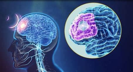 Transcranial Magnetic Stimulator Market Major Key Players 2028