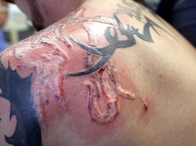 Understanding the Signs of Injury After Laser Tattoo Removal