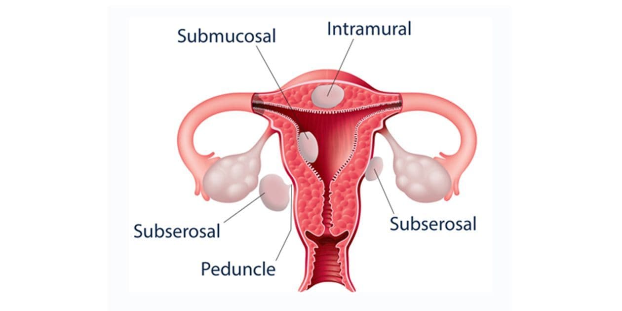 Uterine Leiomyomata Medication Market Size,key Trends