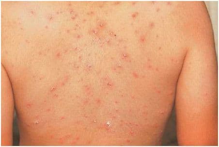 Varicella Zoster Infection Treatment Market Current Trends Report