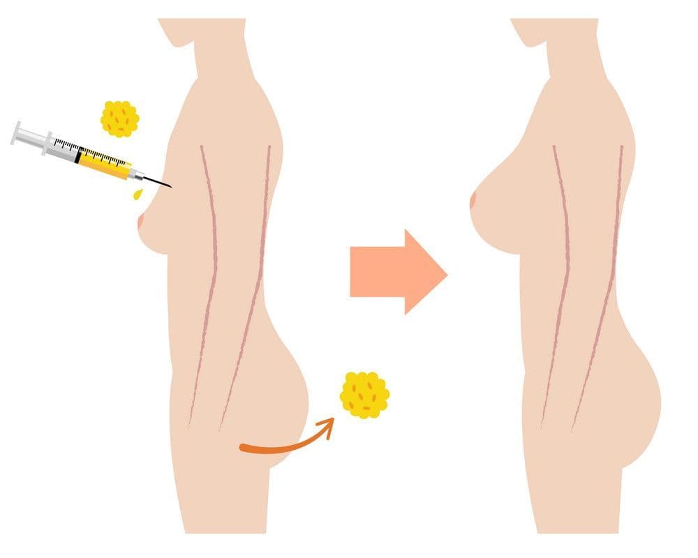 What Is Fat Grafting for Breast Augmentation and How Does It Work