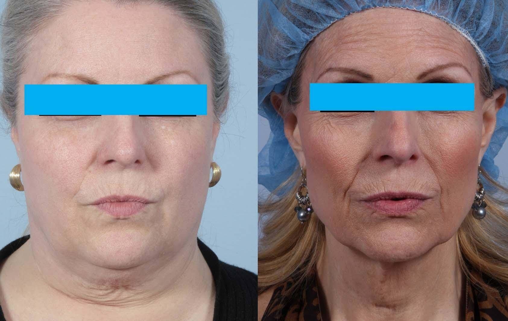 How Weight Loss Changes Your Face